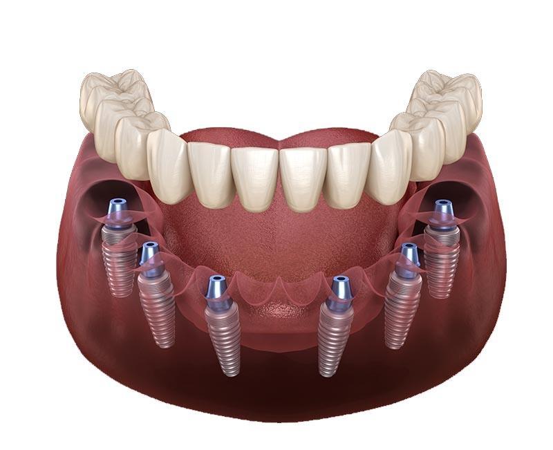 Antalya Dental Implant Treatment