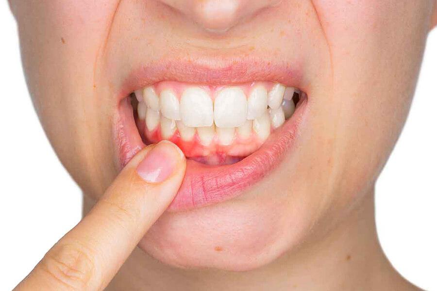 Diş Eti Tedavileri